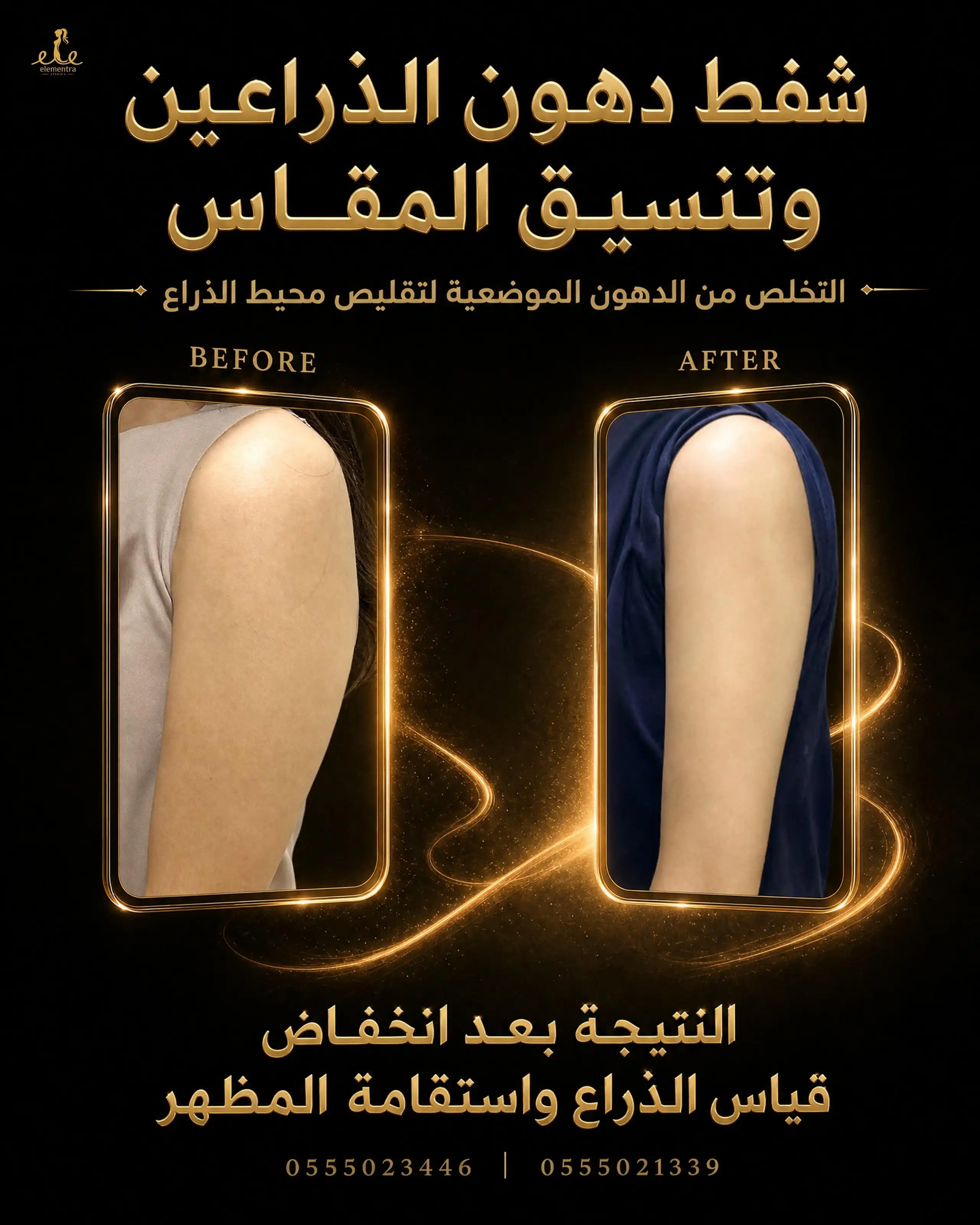 شفط دهون الذراعين وتنسيق المقاس
